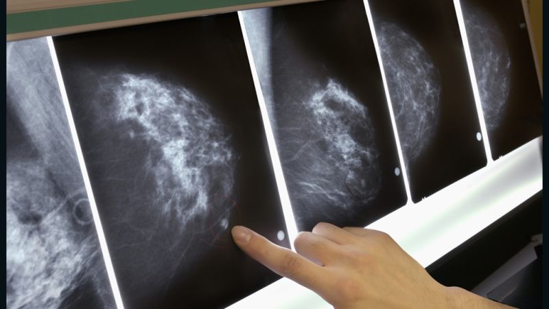 تشخیص سرطان پستان با سنجش تومور مارکرها | بیوپسی سینه اصفهان